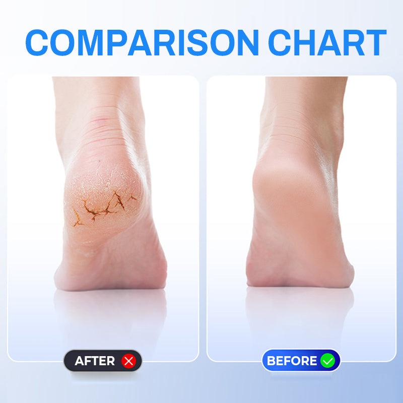 Rechargeable Electric Foot Grinder